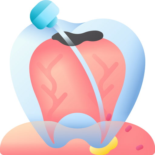 Root Canal Treatment