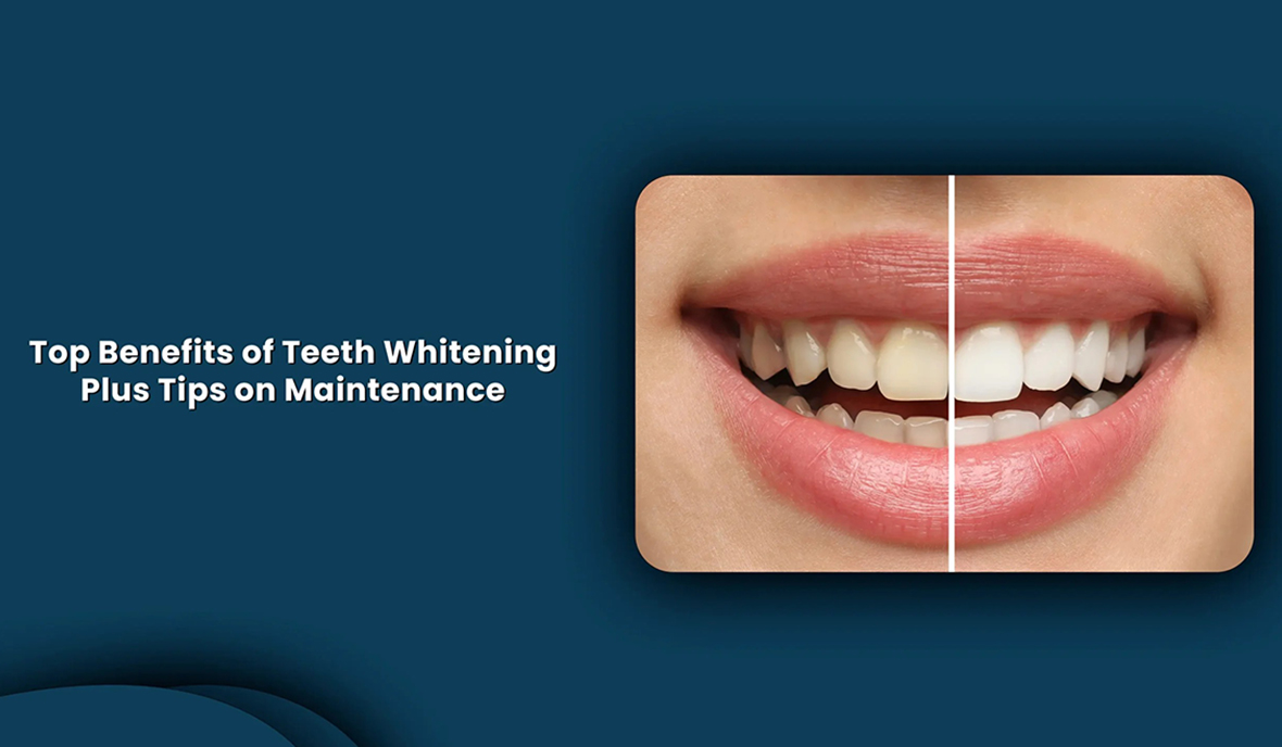 Benefits of Teeth Whitening